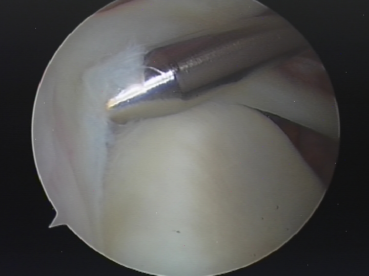 Arthroscopic Picture of SLAP tear.