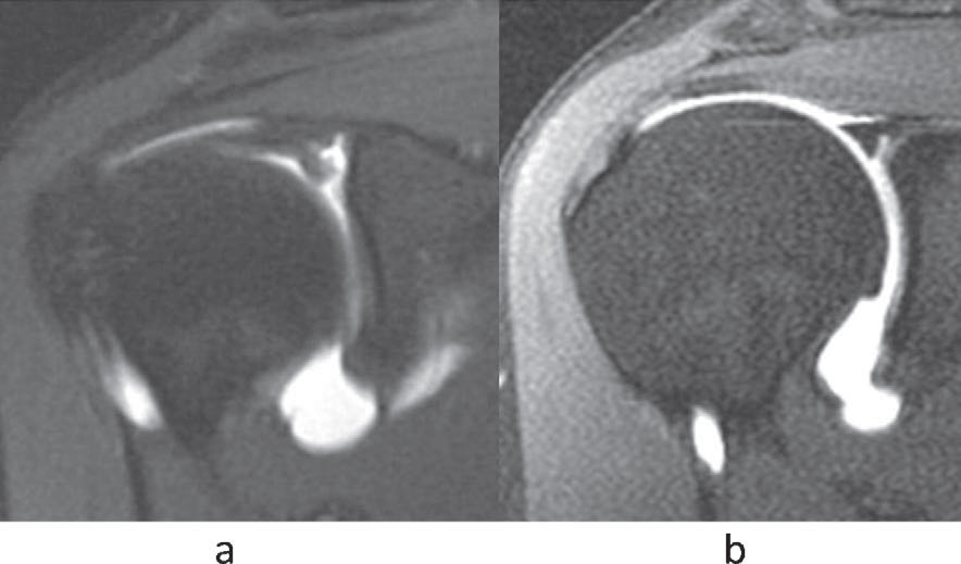 MR Arthrogram showing SLAP tear.