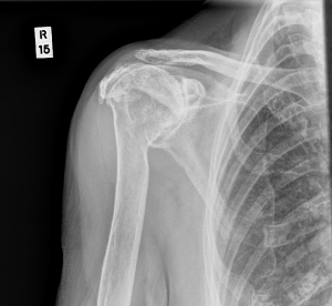 Reverse geometry total shoulder replacement