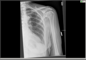 Total shoulder arthroplasty - Fig 2