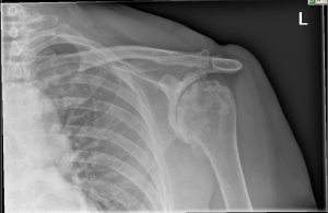 X ray showing Shoulder Osteoarthritis