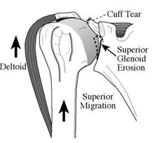 Shoulder Arthiritis