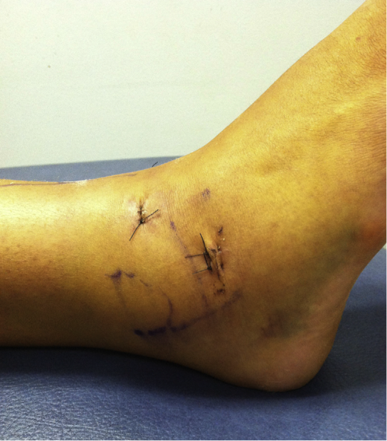 Ankle arthroscopy 2